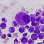 Leucemia - Foto Difu Wu