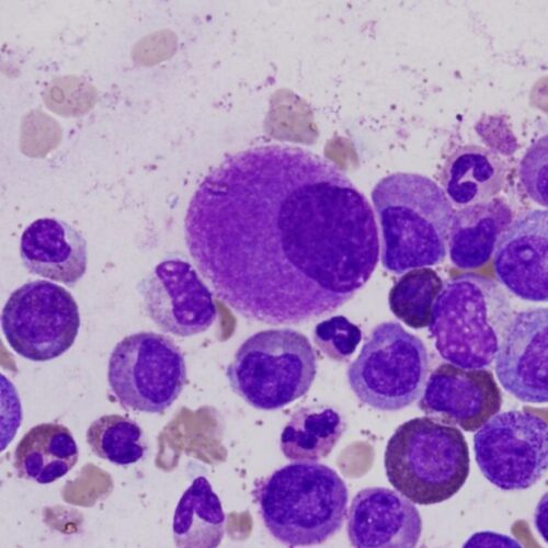 Leucemia, scoperta una possibile causa scatenante