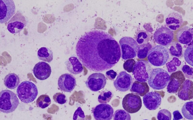 Leucemia, scoperta una possibile causa scatenante